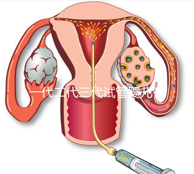 一代二代三代試管嬰兒有什么區(qū)別？