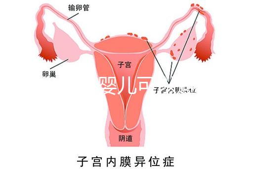 三代試管嬰兒可以避免重癥聯(lián)合免疫缺陷病遺傳嗎
