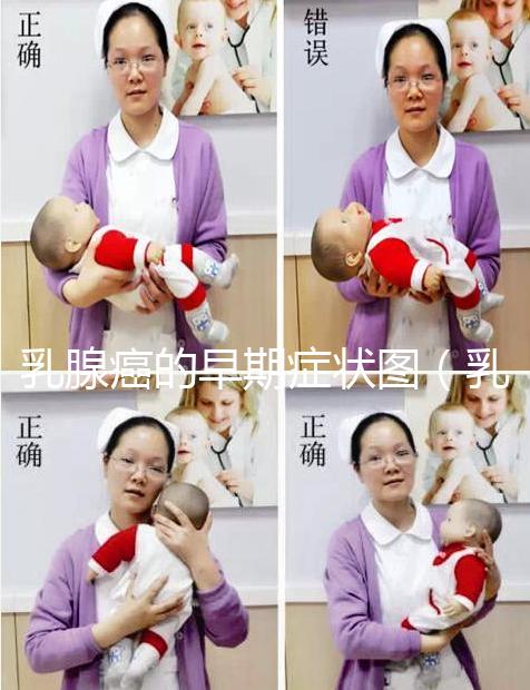 乳腺癌的早期癥狀圖（乳頭狀瘤早期圖片）