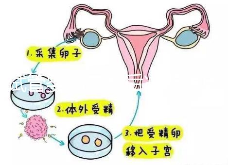 試管嬰兒二超后減藥原因已找到，對胎兒沒影響別瞎擔心